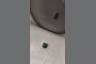 a thumdnail for published video. Prik på håndled