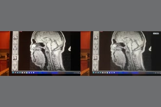 a thumdnail for published video. Aberrant cord motion improvement 
