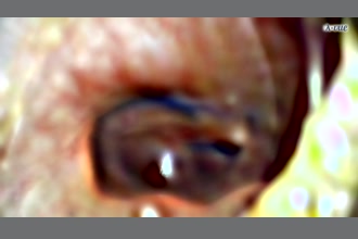 a thumdnail for published video. Colour changes in the eardrum with/without movement