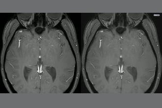 a thumdnail for published video. CSF pulsation over the posterior aspect of the lateral ventricles and third ventricle.