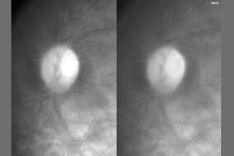a thumdnail for published video. We tried to see if retinal pulsation could be improbed